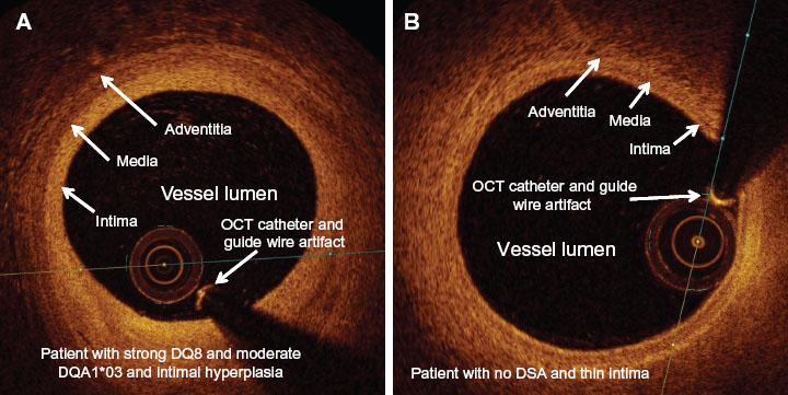 Optical Coherence Tomography Vs Ivus