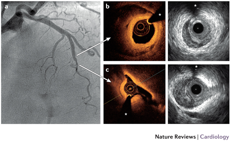 Optical Coherence Tomography Vs Ivus