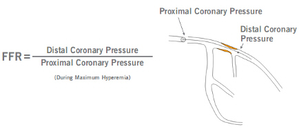 Fractional Flow Reserve (FFR) | CathLab.com